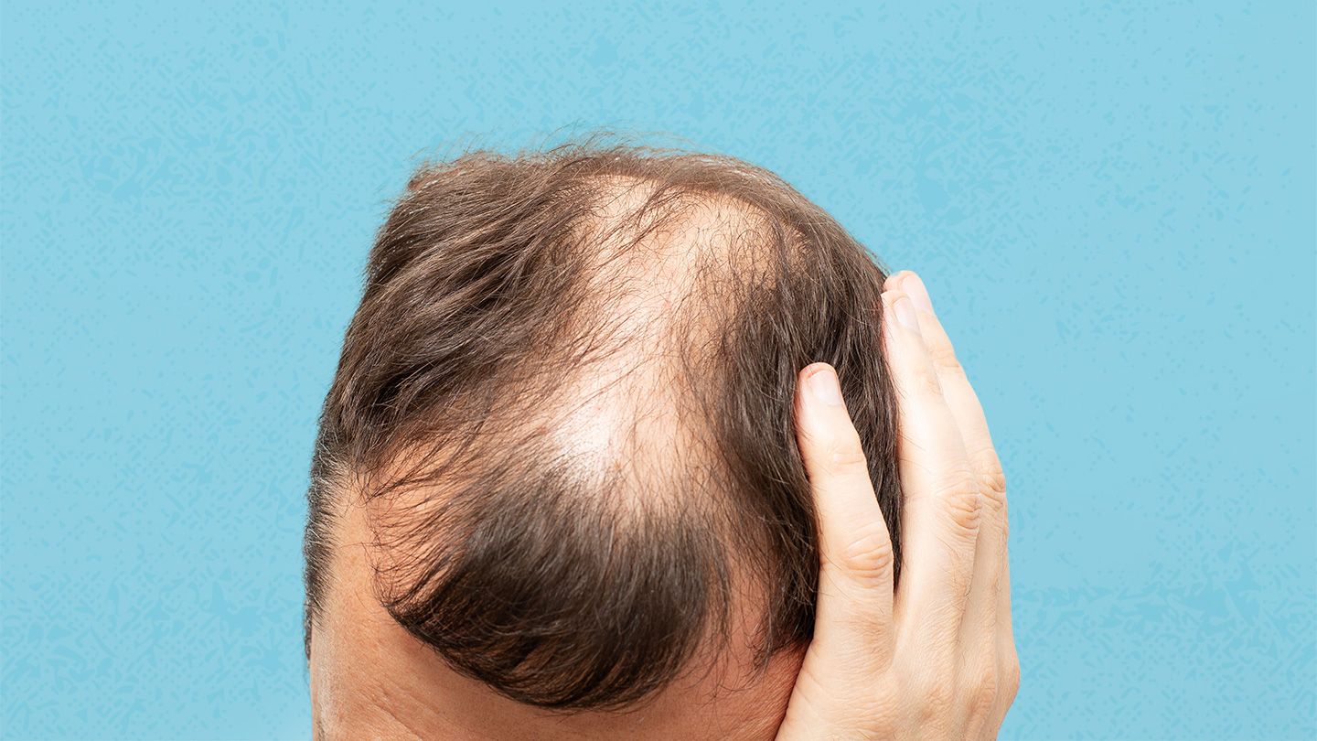 alopekia