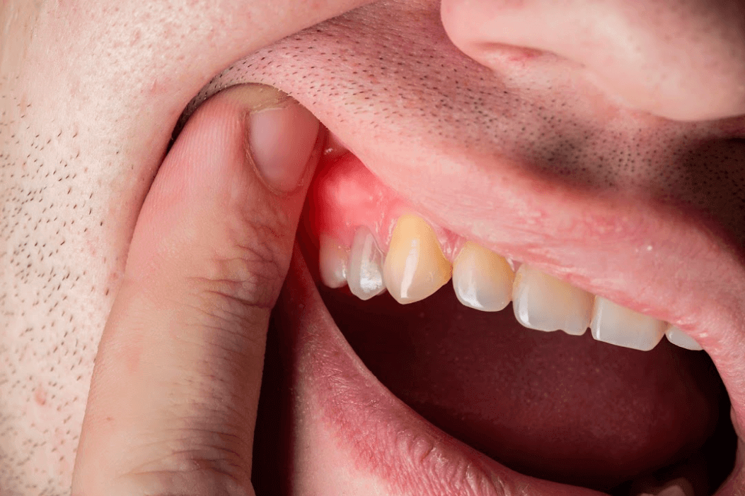 is gum disease contagious
