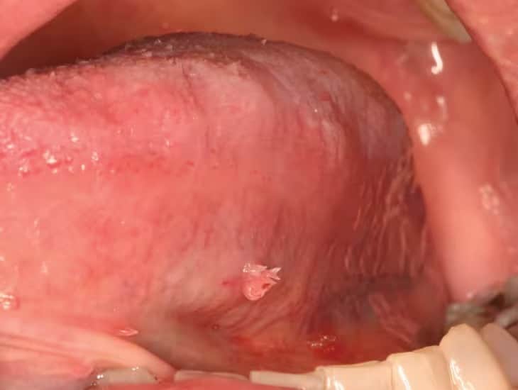 hpv bump on back of tongue 0ral manefistation of hpv 2 11zon
