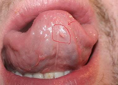 hpv glossa