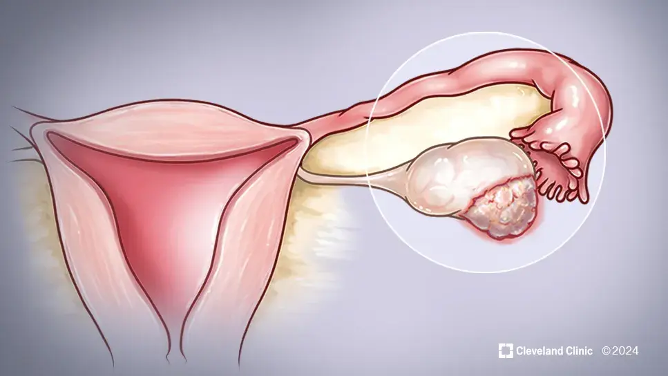 ovarian