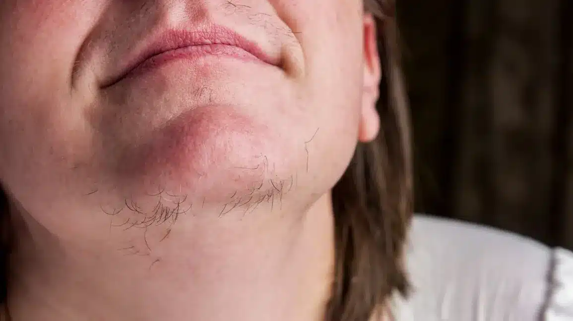 hirsutism