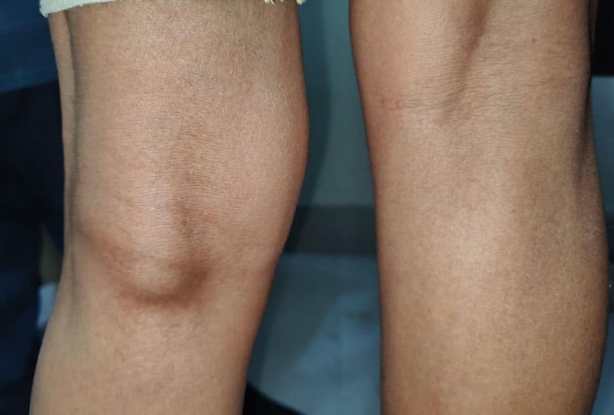 compartment syndrome 2