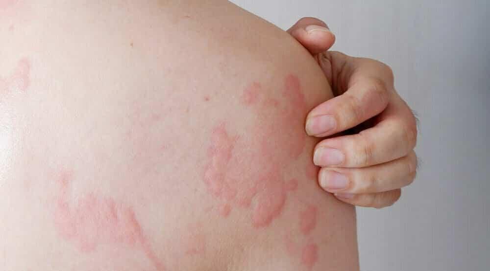 relief from hives urticaria caused by allergies