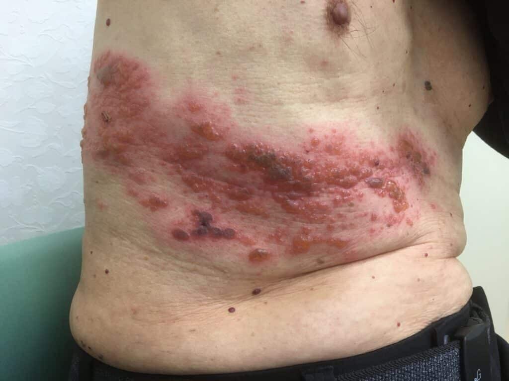herpes