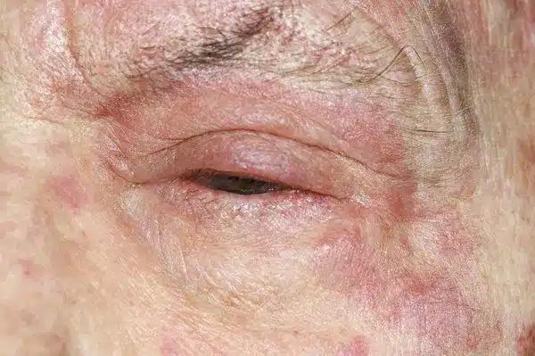 s 0618 shingles rash m2600324.or
