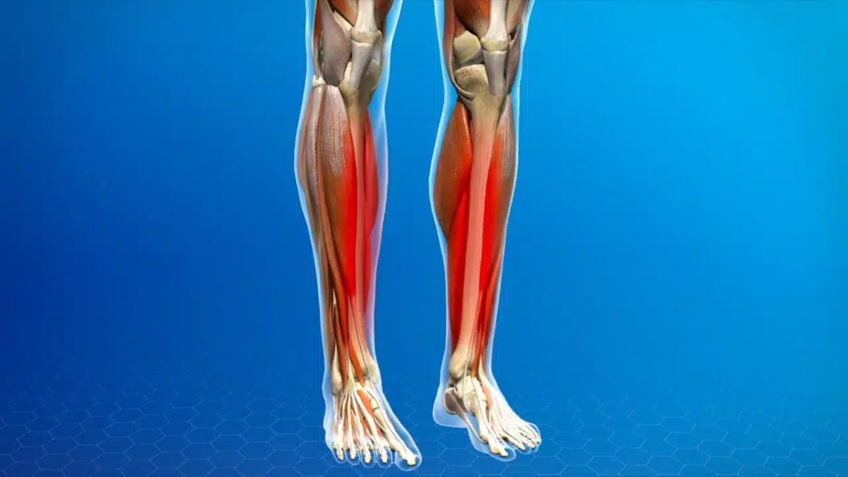 shinsplints