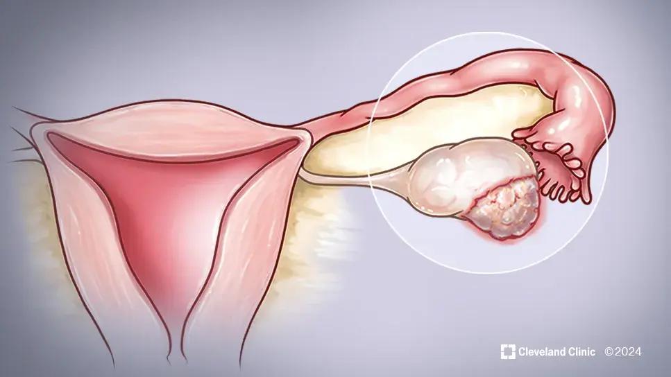 ovarian ca case study cqd 24 whi 5294410