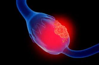 ovarian cancer closeup