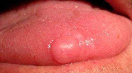 oral cancer 2