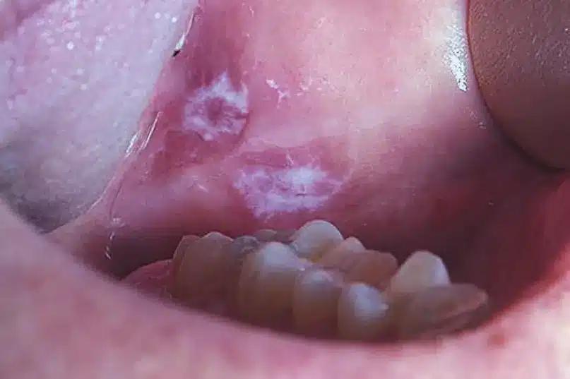 cause of mouth cancer jpg