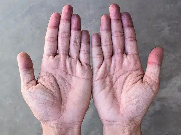 cyanotic hands blue hands thumbn