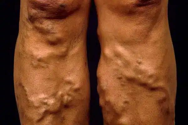 m2900055 varicose veins on a woman s legs be.max 600x600 1