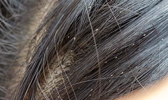 lice