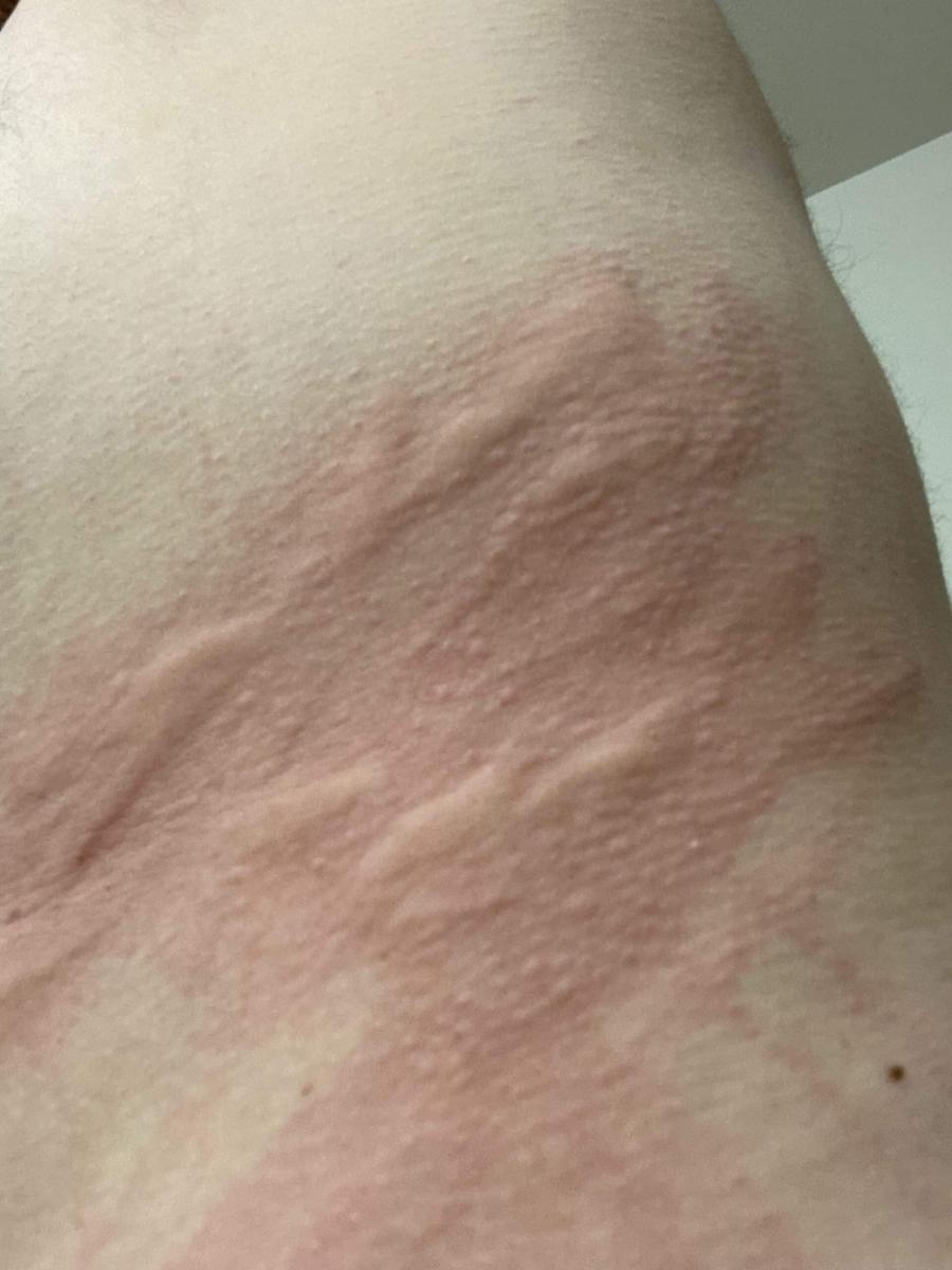lymphoma rash v0 oudncygxxg3e1 scaled