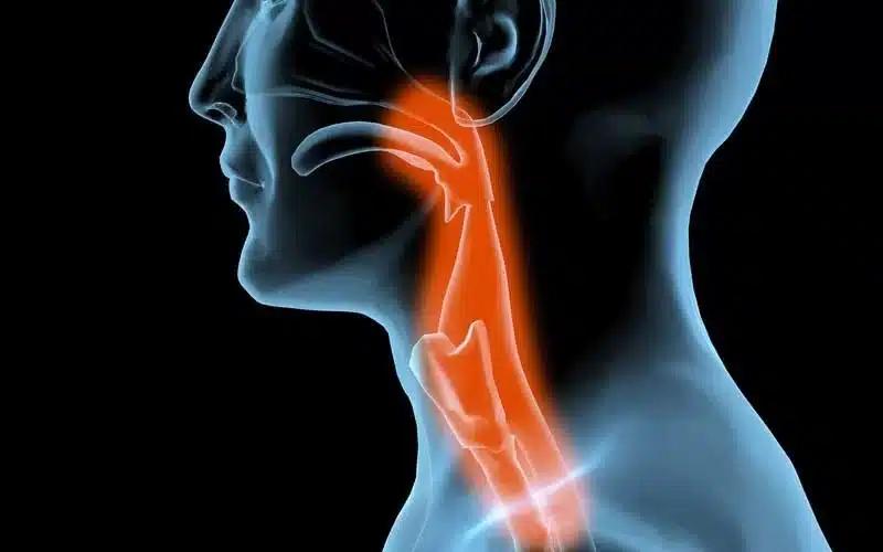 185080 635971468781426781 983899871 dysphagia 60535