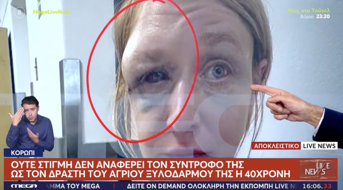 Κορωπί: «Έχουμε σχέση αγάπης με τον σύντροφό μου» λέει η 40χρονη που ξυλοκοπήθηκε – Συγκλονίζει η εικόνα της μετά την κακοποίηση 2 stigmiotypo othonis 2025 10 30 17.46.05