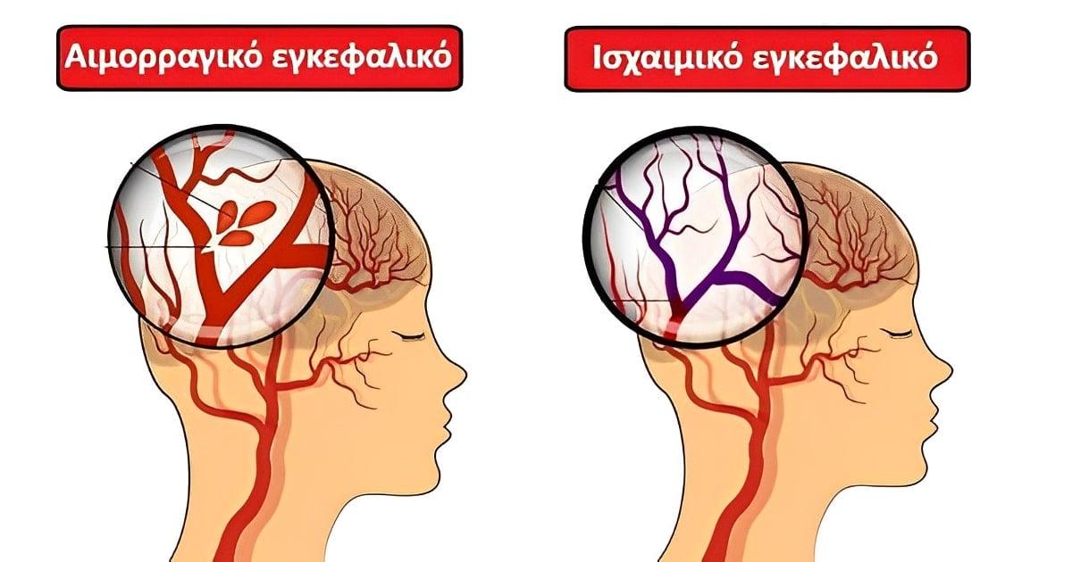 Ένα μήνα πριν από εγκεφαλικό, το σώμα σας προειδοποιεί: 10 σημάδια που δεν πρέπει να αγνοήσετε 2 22222 2