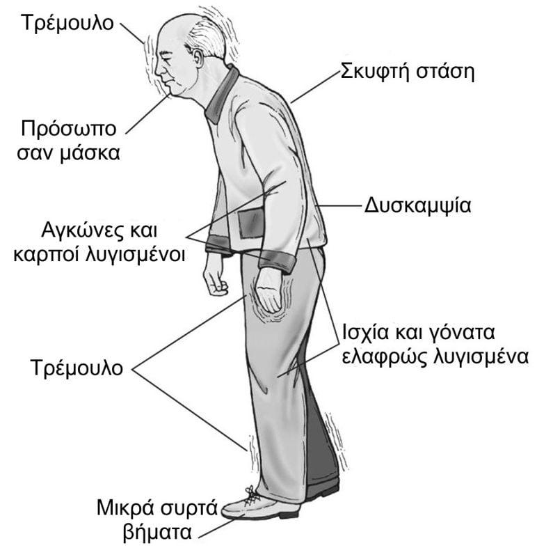 Κίλι Σφακιανάκη: Τι είναι η Νόσος Πάρκινσον από την οποία πέθανε και ποια τα συμπτώματα 2 nosos parkinsson