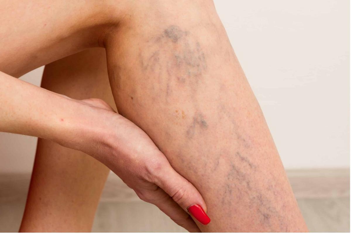 Τα πόδια μας ουρλιάζουν SOS: 5 προειδοποιητικά σημάδια από το συκώτι σας 3 euruaggeies image eleutheriou