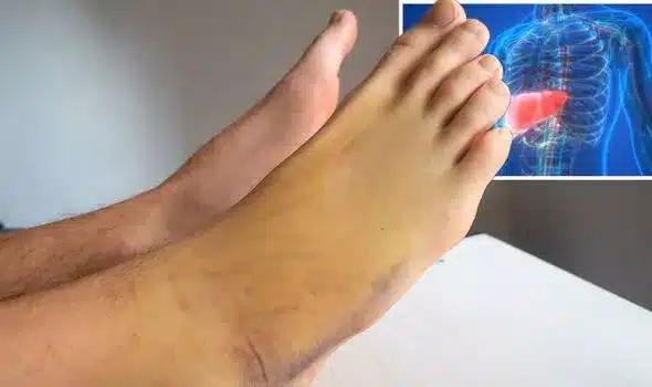 Τα πόδια μας ουρλιάζουν SOS: 5 προειδοποιητικά σημάδια από το συκώτι σας 4 fatty liver disease yellow skin 1415966