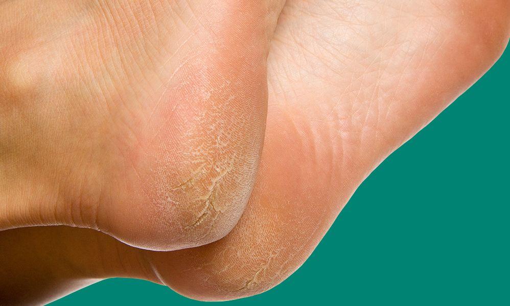7 reasons your feet are peeling