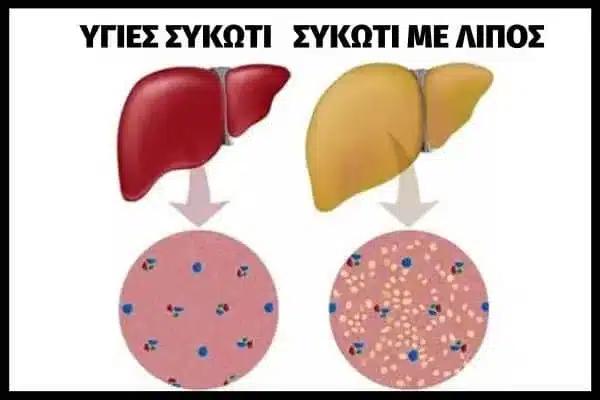 Λίπος στο συκώτι: Τι να τρώτε για να το μειώσετε χωρίς φάρμακα -Τροφές που πρέπει να αποφεύγετε 4 lipos sto sikoti 2