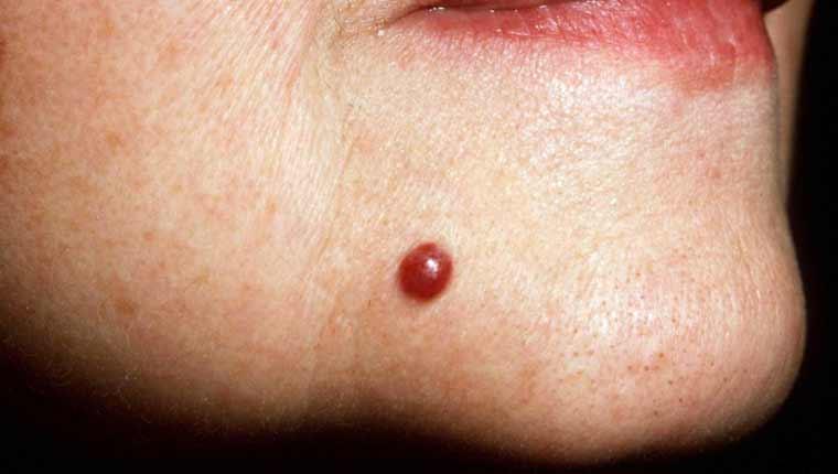 Αν δείτε αυτές τις κόκκινες κουκκίδες στο δέρμα σας είναι καλό να γνωρίζετε τι σημαίνουν 2 aggeiomata featured articles