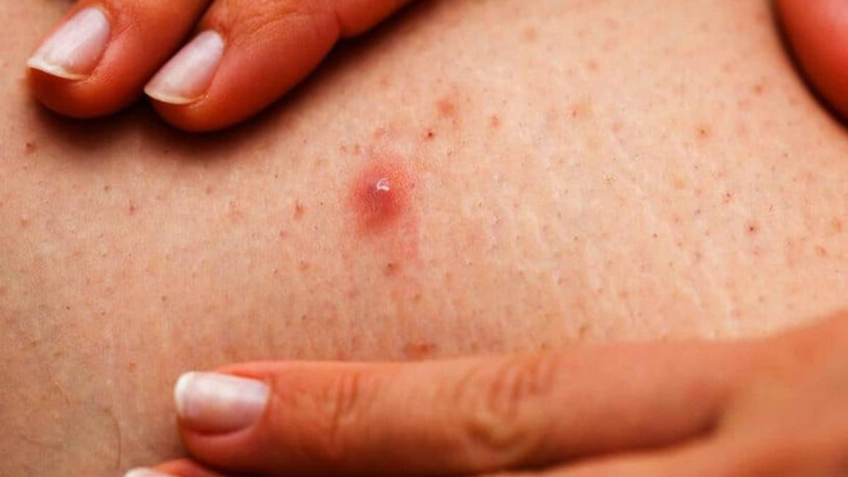 Αν δείτε αυτές τις κόκκινες κουκκίδες στο δέρμα σας είναι καλό να γνωρίζετε τι σημαίνουν 5 thilakitida