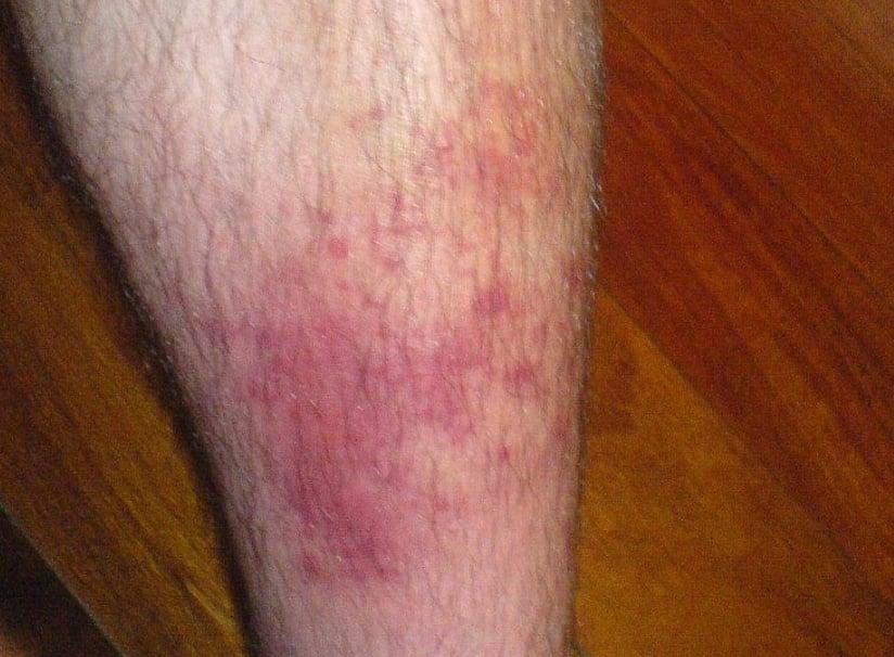 Αν δείτε αυτές τις κόκκινες κουκκίδες στο δέρμα σας είναι καλό να γνωρίζετε τι σημαίνουν 6 stigmiotypo othonis 2024 11 18 19.18.31