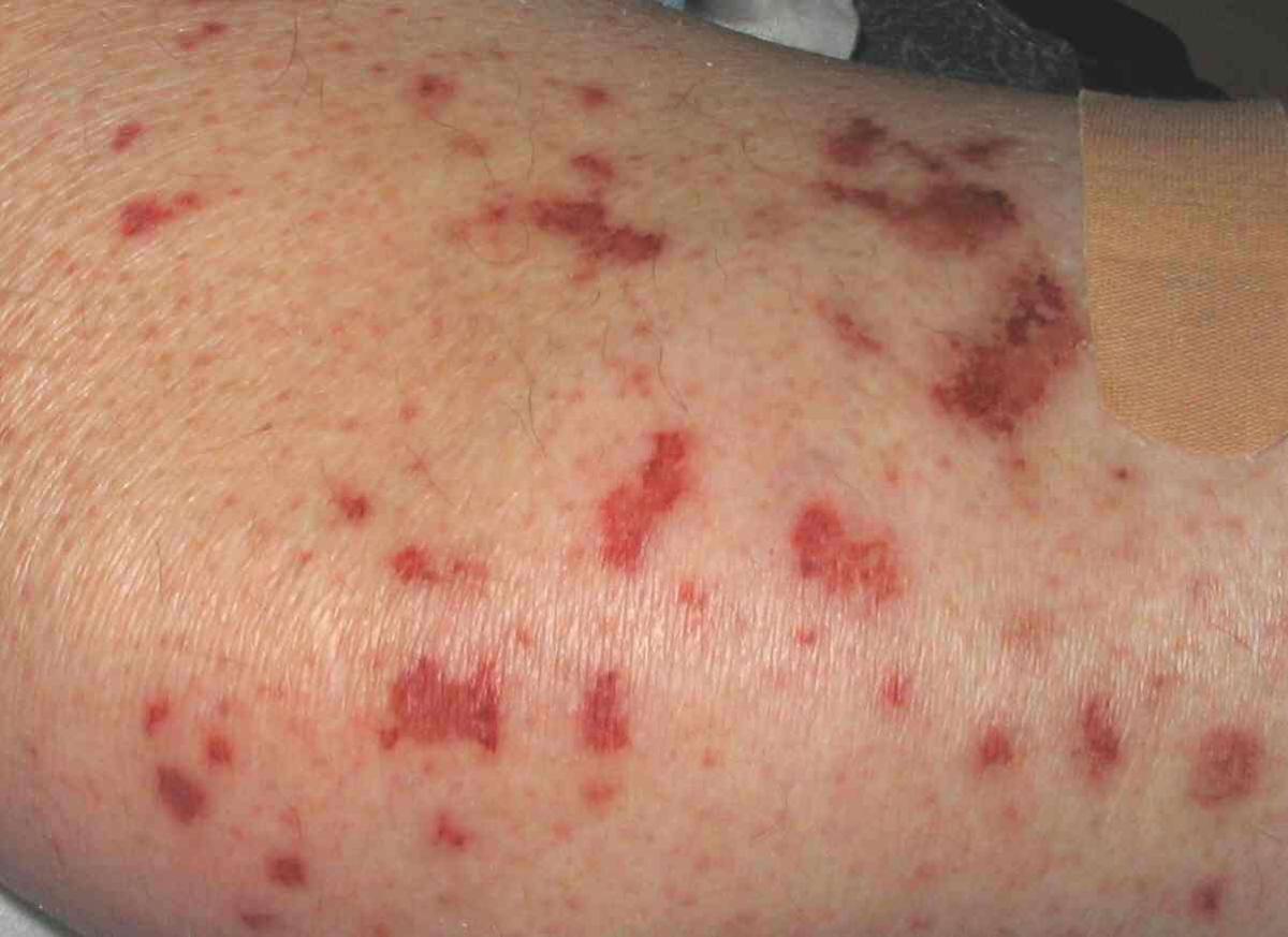 Αν δείτε αυτές τις κόκκινες κουκκίδες στο δέρμα σας είναι καλό να γνωρίζετε τι σημαίνουν 8 aggiitida1