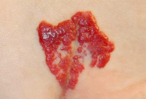 Αν δείτε αυτές τις κόκκινες κουκκίδες στο δέρμα σας είναι καλό να γνωρίζετε τι σημαίνουν 9 gtm p129 image001