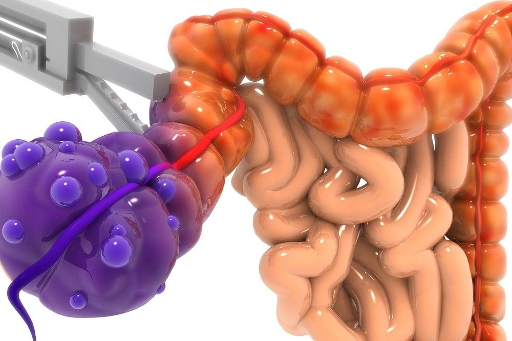 Καρκίνος στο λεπτό έντερο: Προσοχή στα συμπτώματα – Πολλοί τα αγνοούν για μήνες ως «κάτι ασήμαντο» 1 lepto entero
