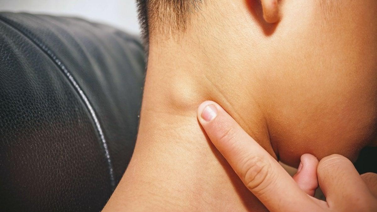 Επιζώντες λεμφώματος μοιράζονται έξι συμπτώματα που είχαν πριν από τη διάγνωση 2 54a84f12 bigstock lymph node inflammation of the 254590171