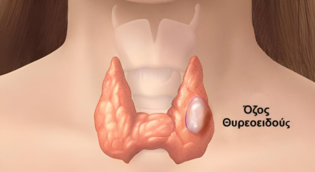 Όζοι θυρεοειδούς: Οι γιατροί συνιστούν να τρώμε λιγότερο από αυτή την τροφή 1 444 2
