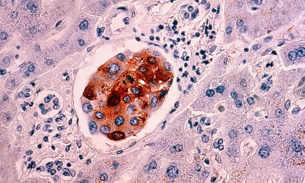 Πώς να μειώσουμε τις πιθανότητες εμφάνισης καρκίνου – Επιστήμονας του Χάρβαρντ προτείνει να «κόψουμε» 5 συνήθειες 1 5200