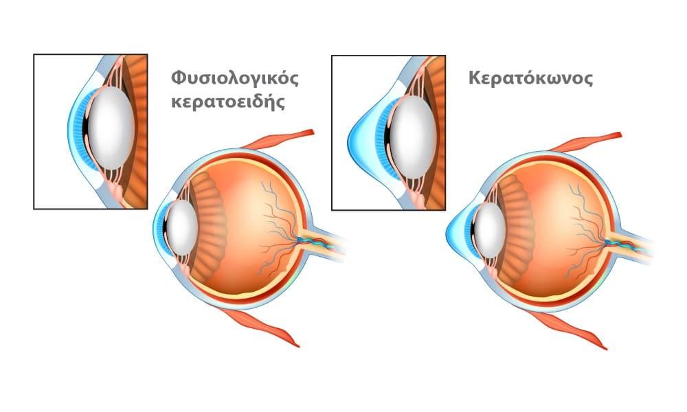 keratokonus 1