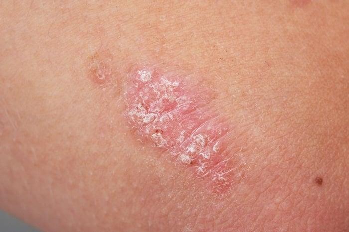 close up of psoriasis on skin ec33a0