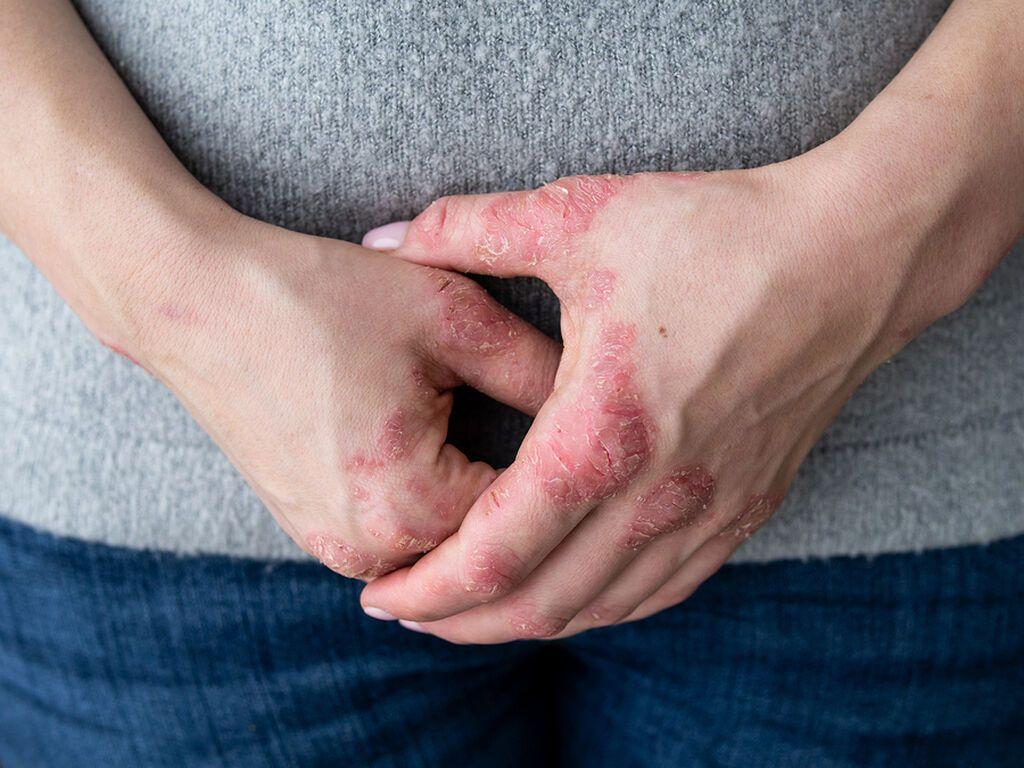 1643645904254 515358190 psoriasis 5