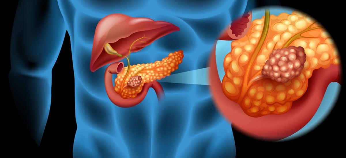 pancreas cancer illustration