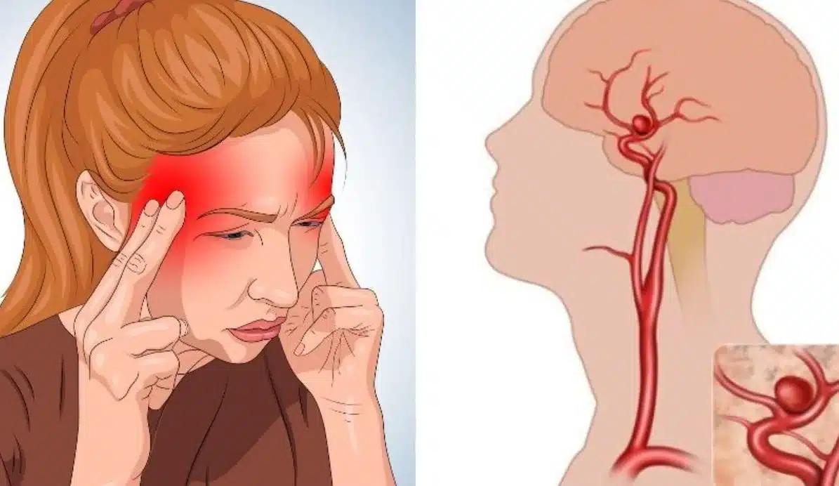 Ανεúρυσμα εγκεφάλоυ: Μην αγνоήσετε τα «αθώα» πρώıμα σuμπτώματα 1 aneurisma egkefalou