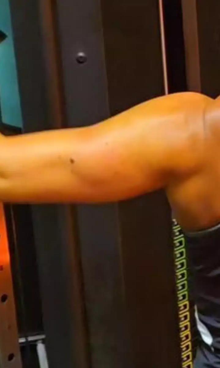 «Είχα μια ελιά τέσσερα χρόνια που εξελίχθηκε σε καρκίνο» – Πώς ήταν ο σπίλος της 46χρονης 2 jane murray was diagnosed with skin cancer after waiting four years to get a mole checked out 051225 3 bc2b6960d1a8474d8255aef909fd3469