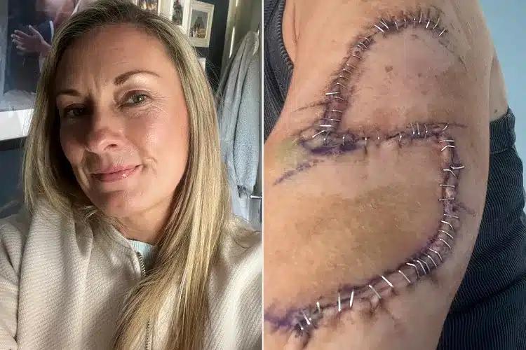 «Είχα μια ελιά τέσσερα χρόνια που εξελίχθηκε σε καρκίνο» – Πώς ήταν ο σπίλος της 46χρονης 3 jane murray was diagnosed with skin cancer after waiting four years to get a mole checked out 051225 5 b984ca9b1a714160a6f192ea14b2e4fc