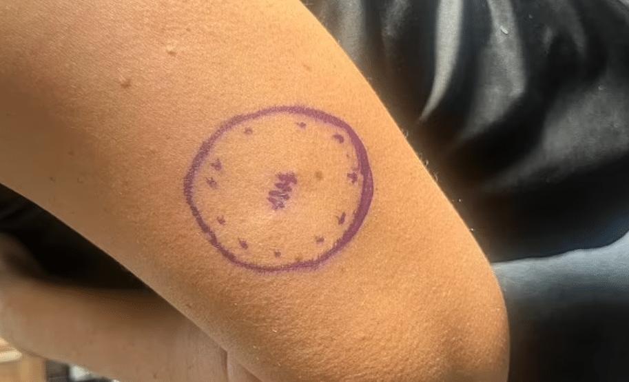 «Είχα μια ελιά τέσσερα χρόνια που εξελίχθηκε σε καρκίνο» – Πώς ήταν ο σπίλος της 46χρονης 4 jane murray 3