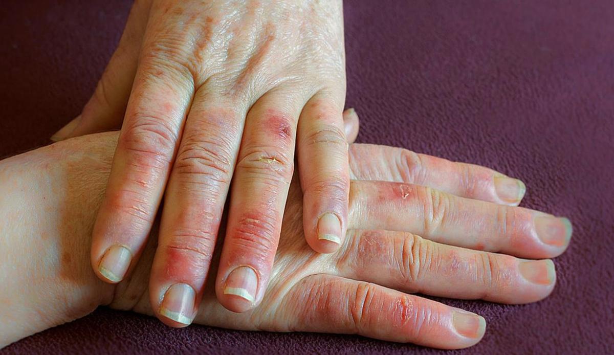 Αν έχετε μούδιασμα στα χέρια, μην αγνοήσετε αυτούς τους 7 λόγους 2 stigmiotypo othonis 2025 12 06 03.00.00