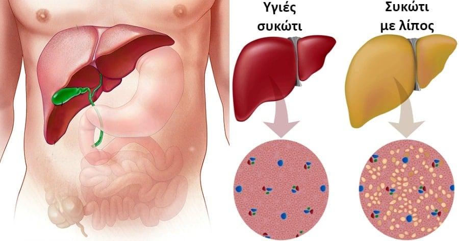Λίπος στο συκώτι: Οι 4 χειρότερες τροφές για το λιπώδες ήπαρ, σύμφωνα με ηπατολόγο 4 igies sikoti