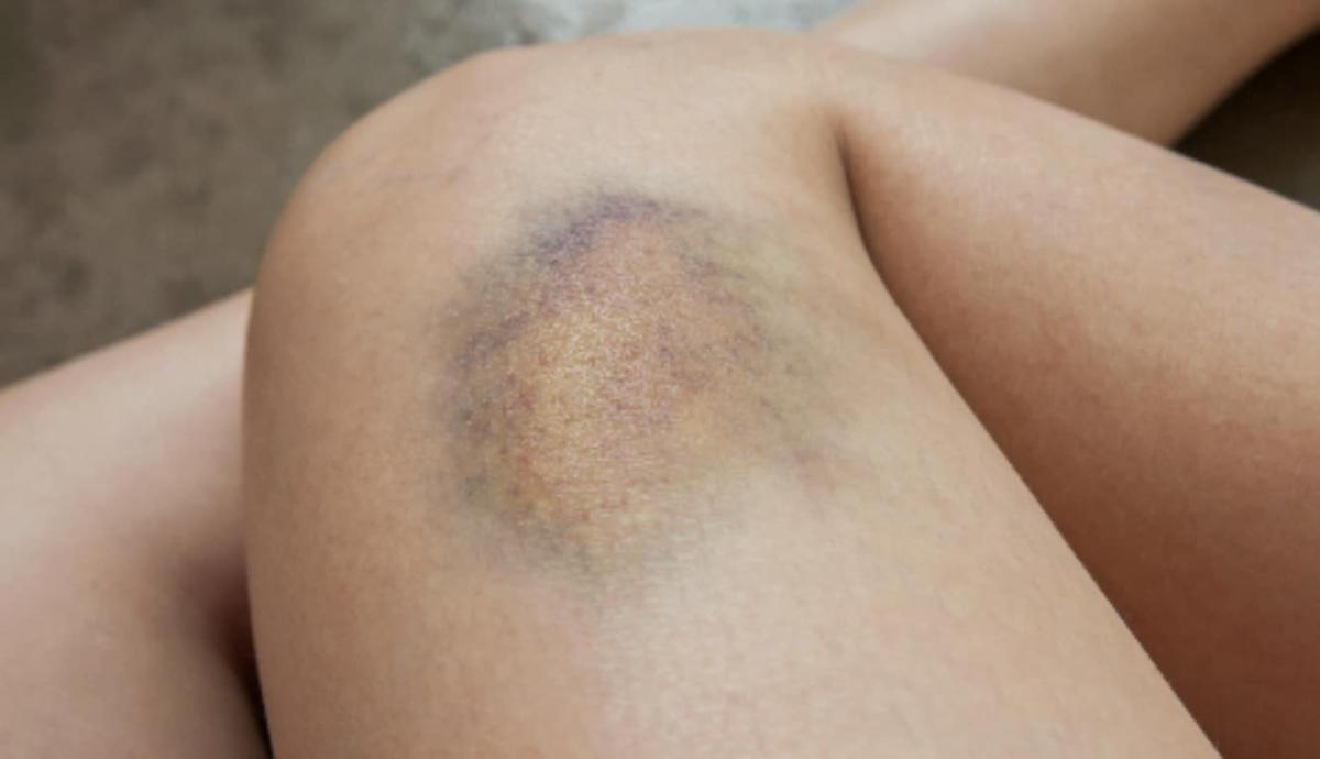 Mελανιές χωρίς ξεκάθαρη αιτία; Δείτε τι μπορεί να σας λέει το σώμα σας 1 stigmiotypo othonis 2025 12 10 00.24.10