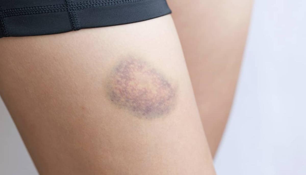 Mελανιές χωρίς ξεκάθαρη αιτία; Δείτε τι μπορεί να σας λέει το σώμα σας 2 stigmiotypo othonis 2025 12 10 00.24.27