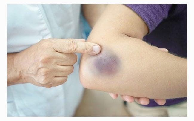 Mελανιές χωρίς ξεκάθαρη αιτία; Δείτε τι μπορεί να σας λέει το σώμα σας 3 bm tim 1