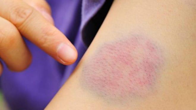 Mελανιές χωρίς ξεκάθαρη αιτία; Δείτε τι μπορεί να σας λέει το σώμα σας 4 1620784238 8223a3ba019ded363b50a3916e118e45 width1280height721